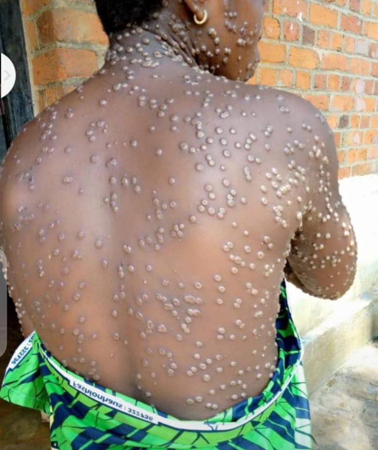 Monkeypox Declared Emergency In Africa